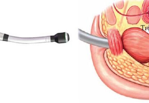 Hướng dẫn chăm sóc sau mổ cắt trực tràng điều trị ung thư trực tràng